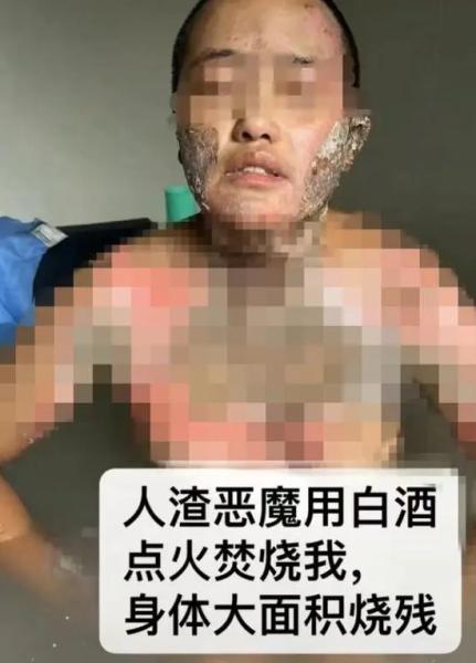 四川凉山州一女子爆料遭丈夫家暴并焚烧，警方和相关部门介入调查